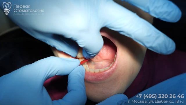 Замена коронок и удаление Восьмёрки. #имплантация #dentist