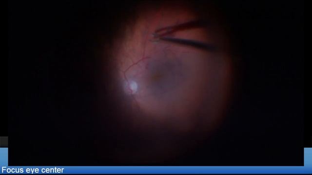 Small pupil Tractional ERM peeling ,Triamcinolon Live Stream смотреть онлайн