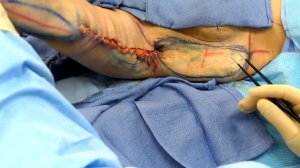 Brachioplasty (Arm Lift Surgery) With Dr. Mark Jabor of El Paso Plastic Surgery