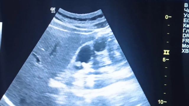 полипы стенки желчного пузыря.  polyps of the gallbladder wall