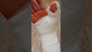 Повреждение сухожилий Сгибатели кисти, срединный и локтевой нерв Реабилитация #1