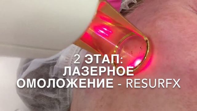 PHOTOFRACTION ФОТОФРАКШН НА АППАРАТЕ М22 IPL  RESURFX. 18.10.2019.