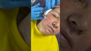 Мастер-класс: iFiller Nucleo 20 в практике косметолога ?#iFillerNucleo #мастеркласс