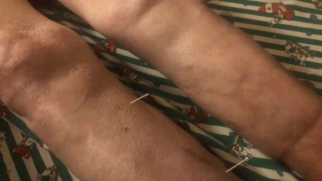 Иглоукалывание Акупунктура Гликман Эдуард Александрович