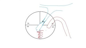 Дефект межжелудочковой перегородки