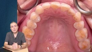 Почему появляются щели между зубами и имплантами?