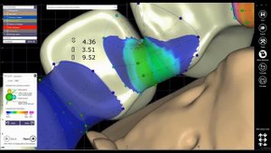 Modifying Bridge Connectors In Exocad