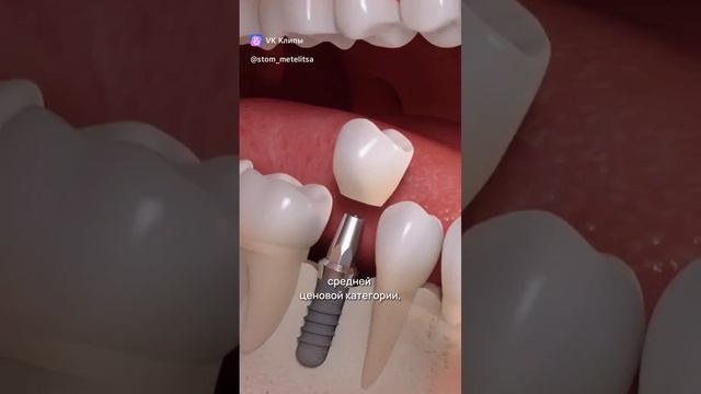 Какой имплант лучше выбрать? В чем отличие производителей имплантов?? смотреть онлайн