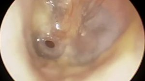 Перфоративный #средний #отит на фоне #отомикоза Диагностика и Лечение в КЛИНИКА ОБРАЗЦОВА