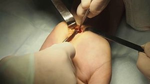 Синдром карпального канала