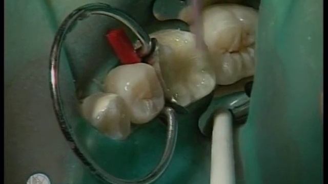 Особенности эстетической реставрации в стоматологии 1-4 смотреть онлайн