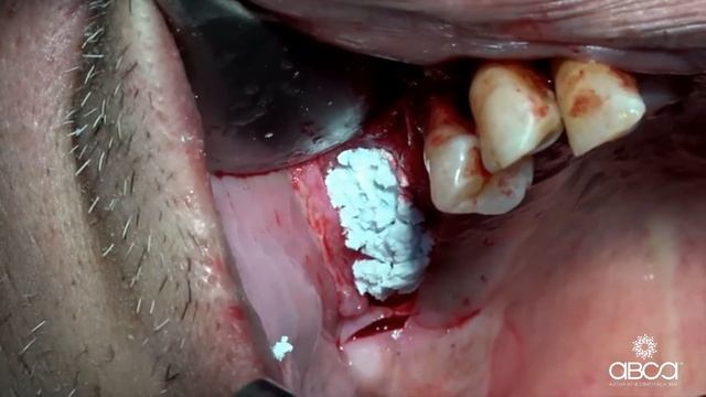 [Instructional Video] Open Sinus Lift Protocol смотреть онлайн