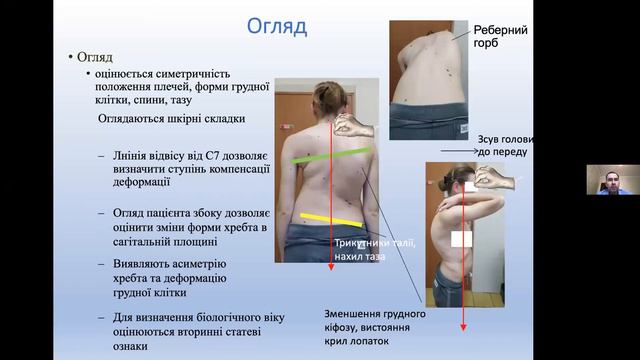 Вебінар - Сколіотична деформація хребта у дорослих смотреть онлайн