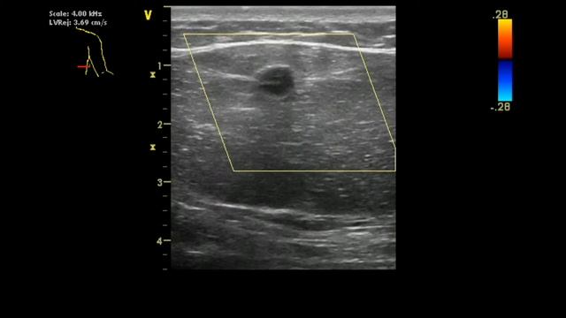 УЗИ лопатки взрослой женщины смотреть онлайн