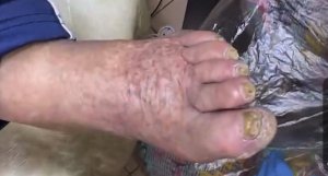 Онихомикоз / Зачистка