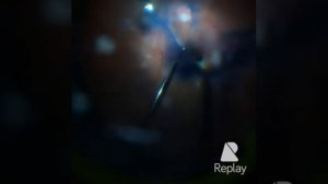 Витрэктомия при диабетической ретинопатии