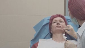 Контурная пластика зоны подбородка. Процедура целиком.