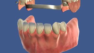 Бюгельный нижний протез