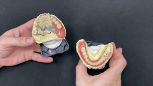 Бюгельные съемные протезы - альтернатива зубной имплантации.
