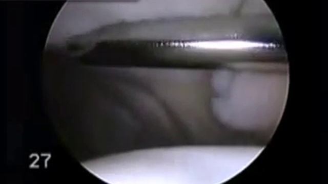 Абразивная хондропластика - СпортКлиника смотреть онлайн