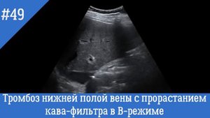 УЗИ сосудов (Видеофрагменты 49, 50). Тромбоз нижней полой вчены с прорастанием кава фильтра.