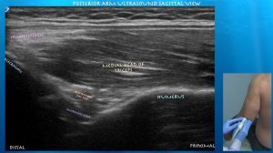 Ultrasound of Normal Triceps Anatomy...by probeultasound.com