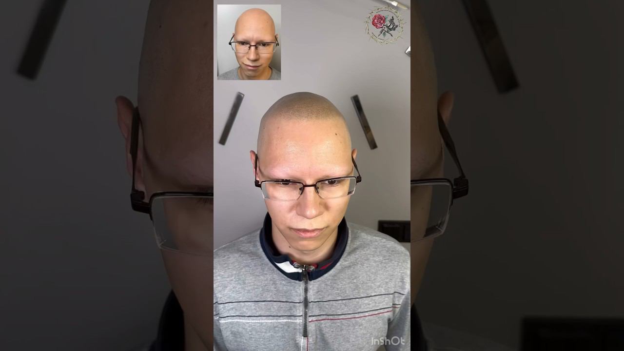 Тотальная алопеция скрыта тату волос, трихопигментация. Scalp micropigmentation SMP alopecia total