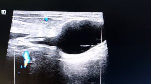 Киста канала Нука