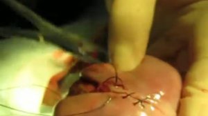 Caesarean section is the suturing of the uterus. Кесарево сечение - ушивание матки. 2073