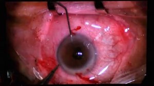 Репозиция с подшиванием дислоцированного комплекса ИОЛ   капсульный мешок