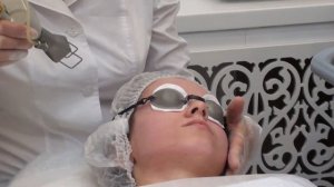 Лазерный пилинг лица