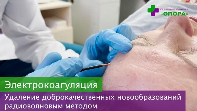 Электрокоагуляция родинок, бородавок и папиллом