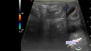 УЗИ кишечника - Кишечная инвагинация, кишечная непроходимость, асцит