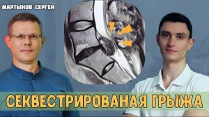 Методы лечения секвестрированной грыжи диска.