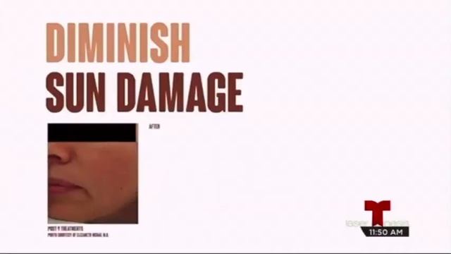 Excel V: New Technology for Blood Vessels - Dr. Montes смотреть онлайн