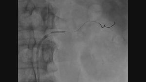 Стентирование почечных артерий