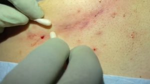 Underboob (infra-mammary) blackhead extractions! Clearing the pores in a common inflamed area.