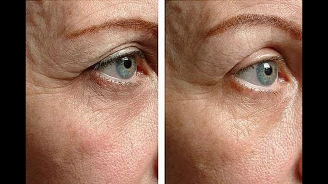 Neolid от мешков под глазами смотреть онлайн