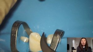 Перелом зуба (глубокий неосложненный перелом коронки зуба) Разбор клинического случая