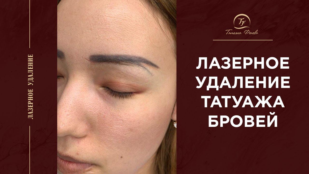 Лазерное удаление перманентного макияжа бровей
