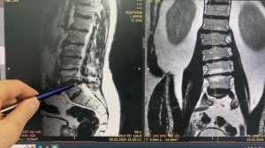 Как читать МРТ? #грыжа #мрт #мануальнаятерапия #невролог