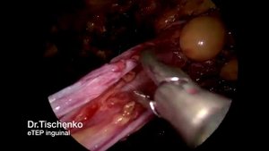 Сложный случай. eTEP паховая грыжа.