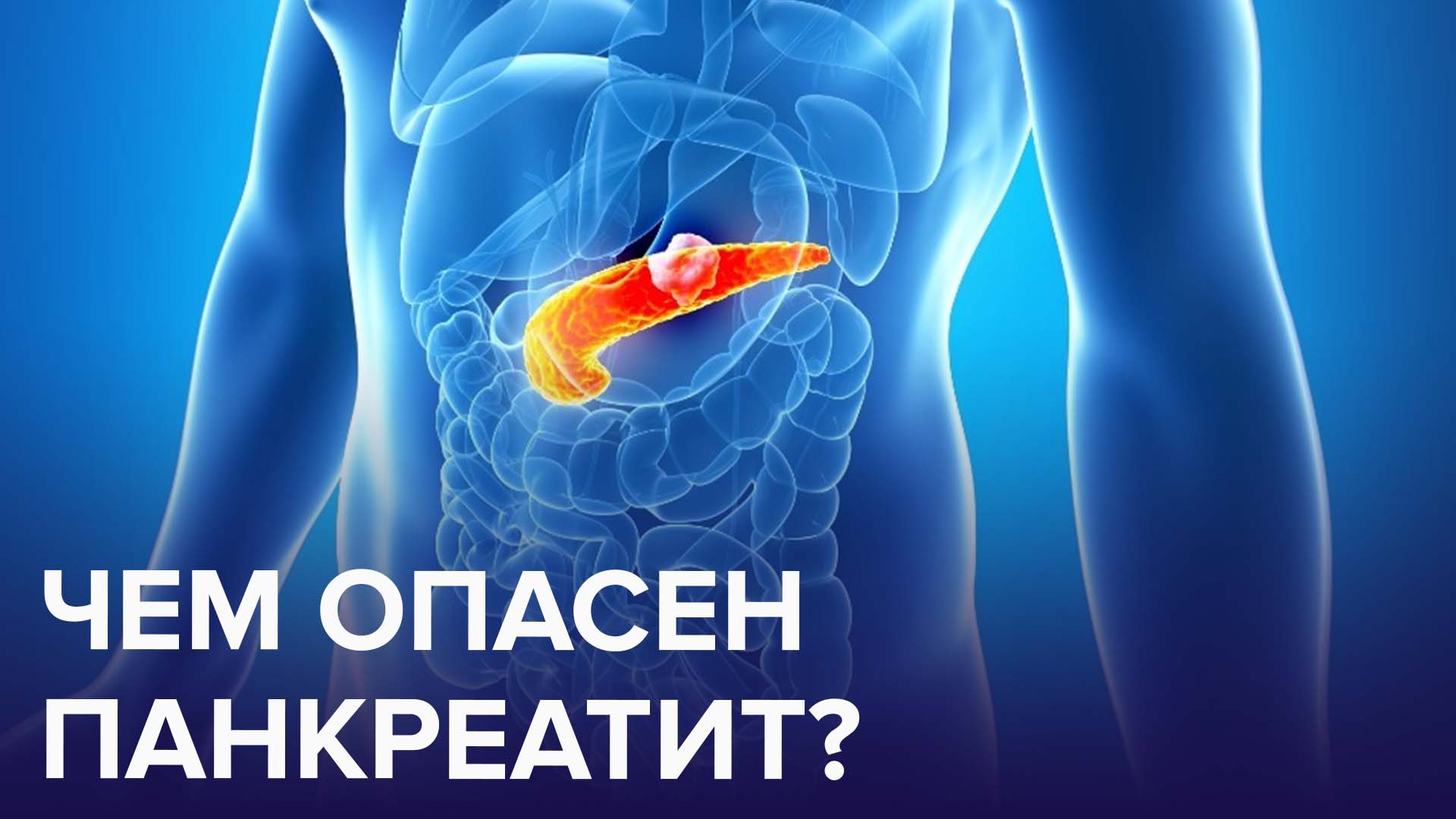 ПАНКРЕАТИТ – болезнь-последствие наших вредных привычек | Доктор 24