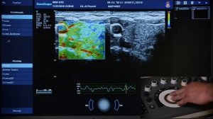 S40Exp 11 Эластография