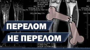 Стресс перелом. Отек кости. Что это такое и как лечить?
