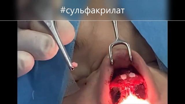 Опыт применения цианакрилатного клея в ринопластике смотреть онлайн