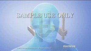 Гамма нож в лечении невралгии тройничного нерва.