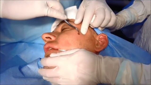 Перелом  левой скуловой дуги смотреть онлайн