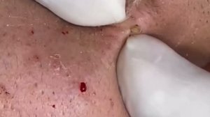 Новое. Чистка лица от черных точек.  New.