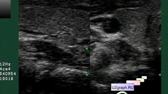 Детское узи щитовидной железы. Добавочная долька щитовидной железы на УЗИ. УЗИ щитовидной железы здоровое поколение. Добавочной долькой железы фото.